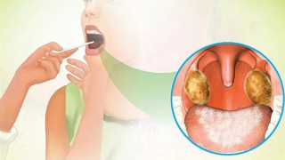 Đề xuất nhu cầu huyết thanh, bố trí kinh phí chống dịch bạch hầu