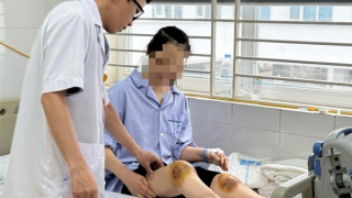 Dùng ong đốt vào đầu gối chữa bệnh, người phụ nữ bị hoại tử cẳng chân