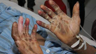 Người đàn ông nhiễm liên cầu lợn sau khi ăn bánh ướt thịt heo