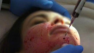 Tự hút máu mình để làm đẹp