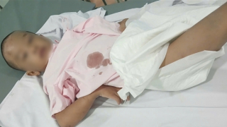 Bé trai 6 tuổi bỏng nặng do bị tạt nước sôi