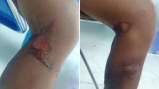 Bé trai 6 tuổi bị bỏng nặng, nghi do bạo hành