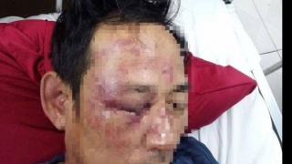 Giám định thương tật người bị đánh khi làm thơ đăng trên Facebook