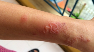 Cụ ông nguy kịch vì nhiễm giun lươn lan toả