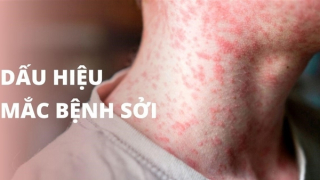 Nhiều người lớn sốt cao nhưng không biết bị mắc sởi nặng