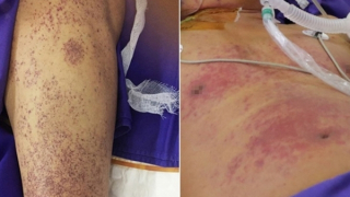 Một thợ xây mắc bệnh lý nguy hiểm do nhiễm liên cầu lợn