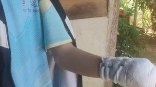 Chơi pháo, nam sinh mất cả bàn tay