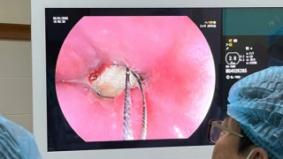 Phẫu thuật cứu sống nam thanh niên mắc dị vật sắc nhọn ở thực quản