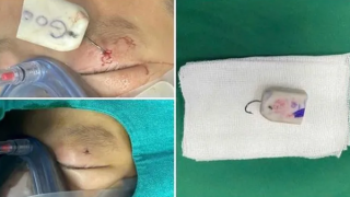 Bé trai 8 tuổi bị lưỡi câu móc sâu vào mắt