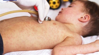 Mở rộng tiêm vaccine sởi ra nhiều tỉnh, thành phố