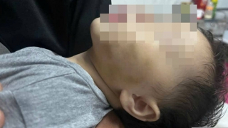 Xung quanh vụ bé gái 9 tháng tuổi ở Đắk Lắk phải nhập viện sau khi gửi nhà trẻ