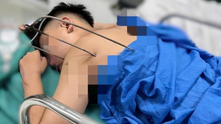 Cứu sống thiếu niên bị đinh ba đâm vào tim nguy kịch