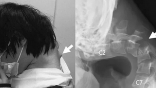 Nam thanh niên Nhật Bản mắc hội chứng hiếm vì dùng smartphone cả ngày