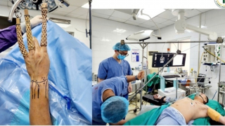 Bệnh viện 19-8 phẫu thuật nội soi nối rách đĩa sụn sợi tam giác cổ tay với trợ cụ đặc biệt tự tạo