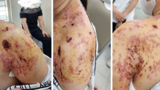 Bó lá điều trị gãy xương đòn, người phụ nữ ở Hà Nội bị bỏng da và nhiễm trùng nặng