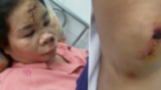 Xác minh thông tin vụ cướp giật khiến người phụ nữ bị chấn thương sọ não