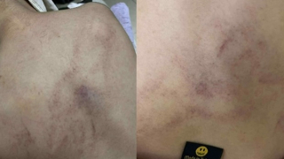 Điều tra vụ bé gái 4 tuổi bị giáo viên mầm non đánh đập, kéo lê, ném vào tường