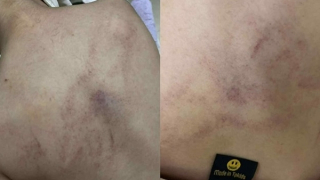 Hà Nội: Tạm đình chỉ giáo viên mầm non bạo hành bé gái