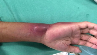 2 ca bệnh nhiễm “vi khuẩn ăn thịt người” ở Đắk Lắk sắp xuất viện