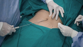 Hút mỡ giá rẻ, phải trả giá quá đắt