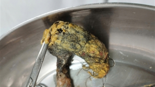 Phẫu thuật thành công cho bệnh nhi 4 tuổi bị hội chứng “Công chúa tóc mây”