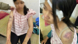 Bé gái 13 tuổi bị ông bà bạo hành đến mức nhập viện cấp cứu