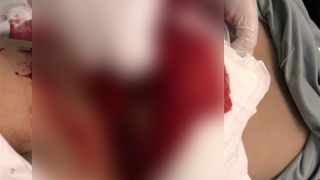 Bé trai gặp thương tích nghiêm trọng khi bồn cầu bị vỡ