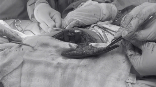 Tái tạo lưỡi cho bệnh nhân ung thư bằng vạt đùi