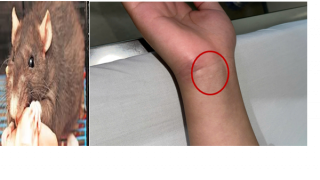 Mắc bệnh nguy hiểm sau khi bị chuột cắn