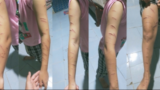 Điều tra vụ nữ sinh lớp 5 ở Cà Mau bị nhiều vết thương