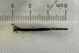 Hy hữu: Xương cá dài 3cm đâm xuyên đường mật