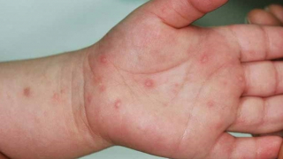 Bệnh tay chân miệng tăng 5 lần, Bộ Y tế hoả tốc yêu cầu ứng phó