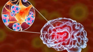 Bộ Y tế khuyến cáo bệnh viêm não mô cầu sau 4 trường hợp tử vong