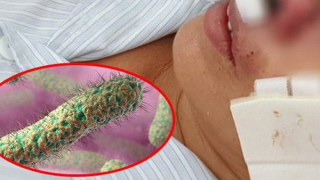 Bộ Y tế khuyến cáo về bệnh Whitmore sau 23 ca tử vong ở Thái Lan