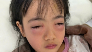 Bé gái 5 tuổi bị viêm kết mạc dị ứng sau khi chơi thổi bong bóng xà phòng