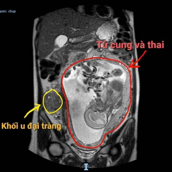 Phẫu thuật nội soi cứu sống thai phụ bị ung thư đại thực tràng hiếm gặp -0