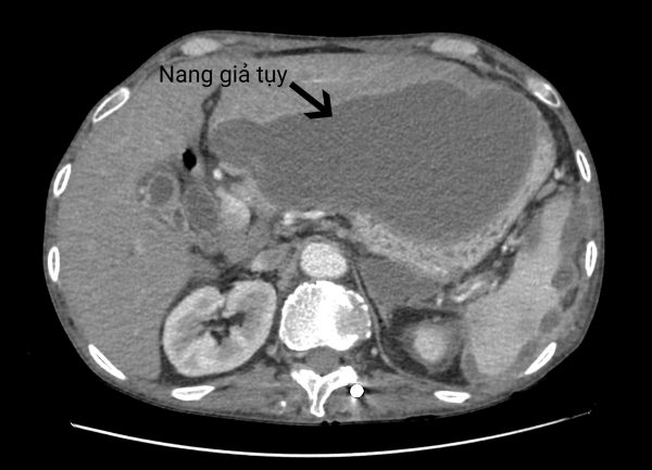 Nam bệnh nhân mắc nang giả tụy cực khủng   -0