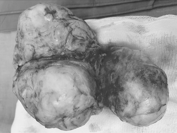 Bóc tách thành công khối u khủng gần 21 cm trong tử cung một phụ nữ  -1