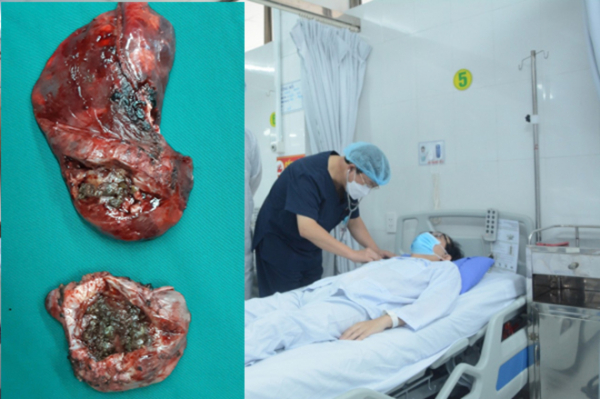 Bóc 2 khối u nấm khủng “mọc ổ” trong phổi nam thanh niên -0