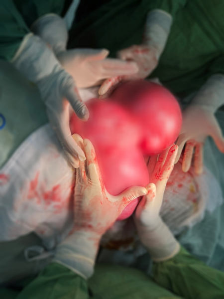 Đà Nẵng: Một phụ nữ “mang nặng” khối u xơ 4.5kg trong tử cung  -1