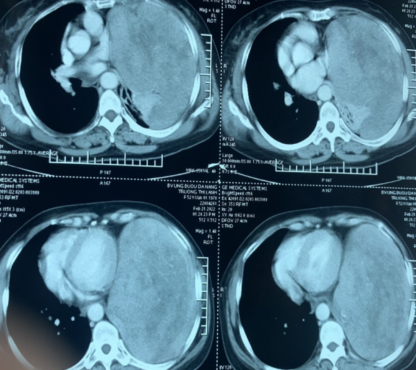 Đà Nẵng: Một phụ nữ bị khối u hơn 3kg chèn ép tim phổi  -0