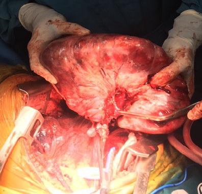 Đà Nẵng: Một phụ nữ bị khối u hơn 3kg chèn ép tim phổi  -1
