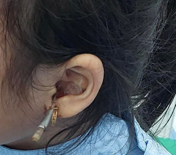 Bé gái 6 tuổi bị cây lấy ráy tai đâm vào tai giữa -0
