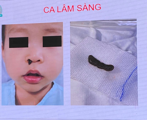 Hai ca lấy dị vật đặc biệt tại Bệnh viện tai mũi họng TP Hồ Chí Minh -0