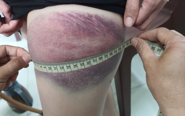 Một phụ nữ bị BVDP dùng gậy đánh bầm tím tay chân -0