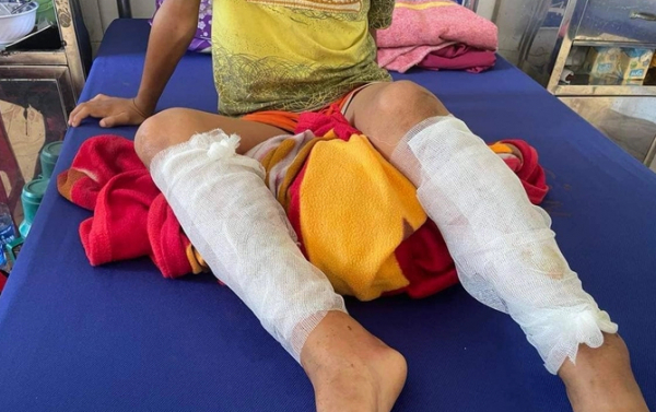 Cháu bé bị bỏng nặng do cha ruột dùng xăng và rơm đốt  -0