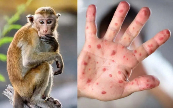 Bộ Y tế xếp đậu mùa khỉ vào bệnh truyền nhiễm nhóm B -0