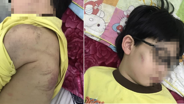 Cháu bé 8 tuổi ở Quảng Ninh bị mẹ bạo hành phải nhập viện -0