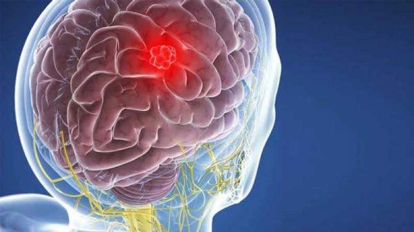 Đau đầu kéo dài nhiều năm, không ngờ có khối u màng não “khủng” gần bằng quả lựu -0