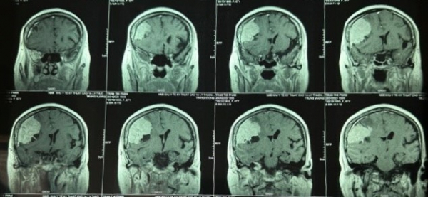 Đau đầu kéo dài nhiều năm, không ngờ có khối u màng não “khủng” gần bằng quả lựu -0